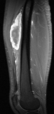 Figure 6 for case vastus intermedius intramuscular hematoma ( RID2702 )